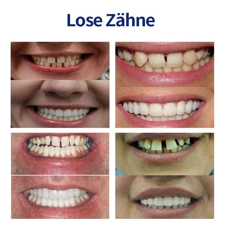 Hermsa® 🦷Fortschrittliches, individuelles Vollprothesen-Set🦷 (⏰Befristeter Rabatt für die letzten 30 Minuten⏰)